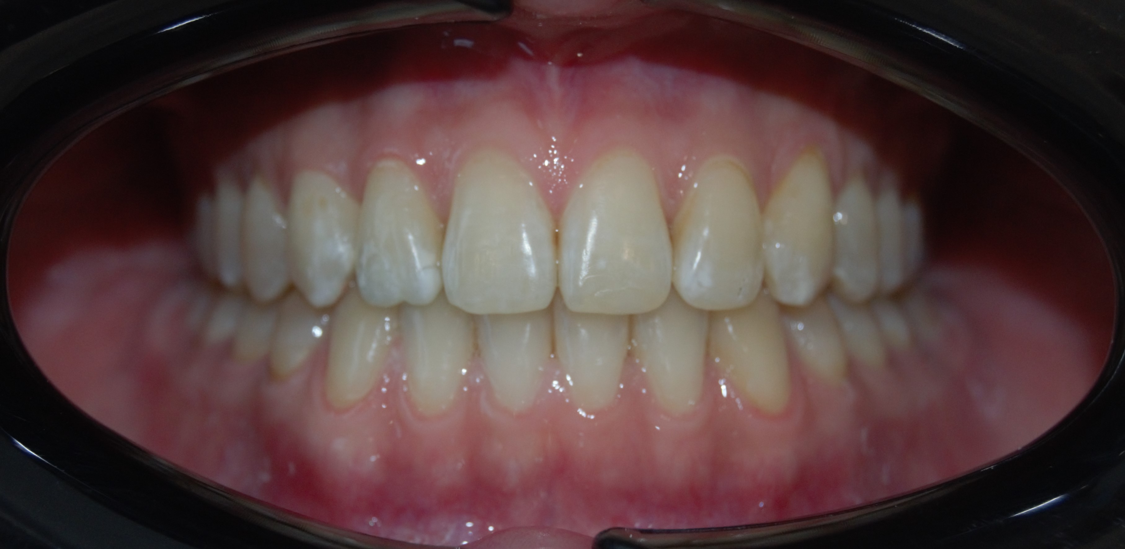 Дистопия зубов - после лечения