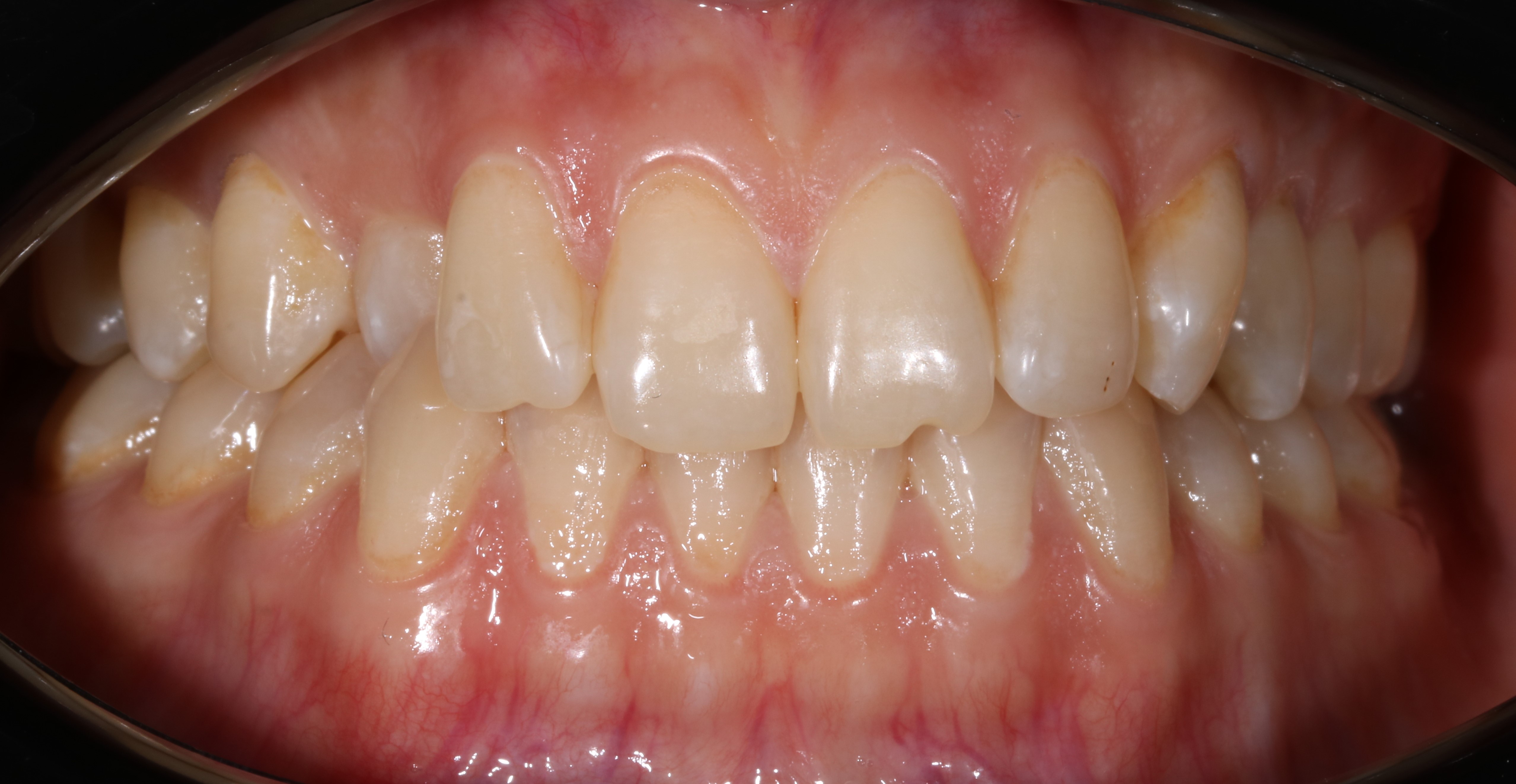 Дистопия зубов - до лечения