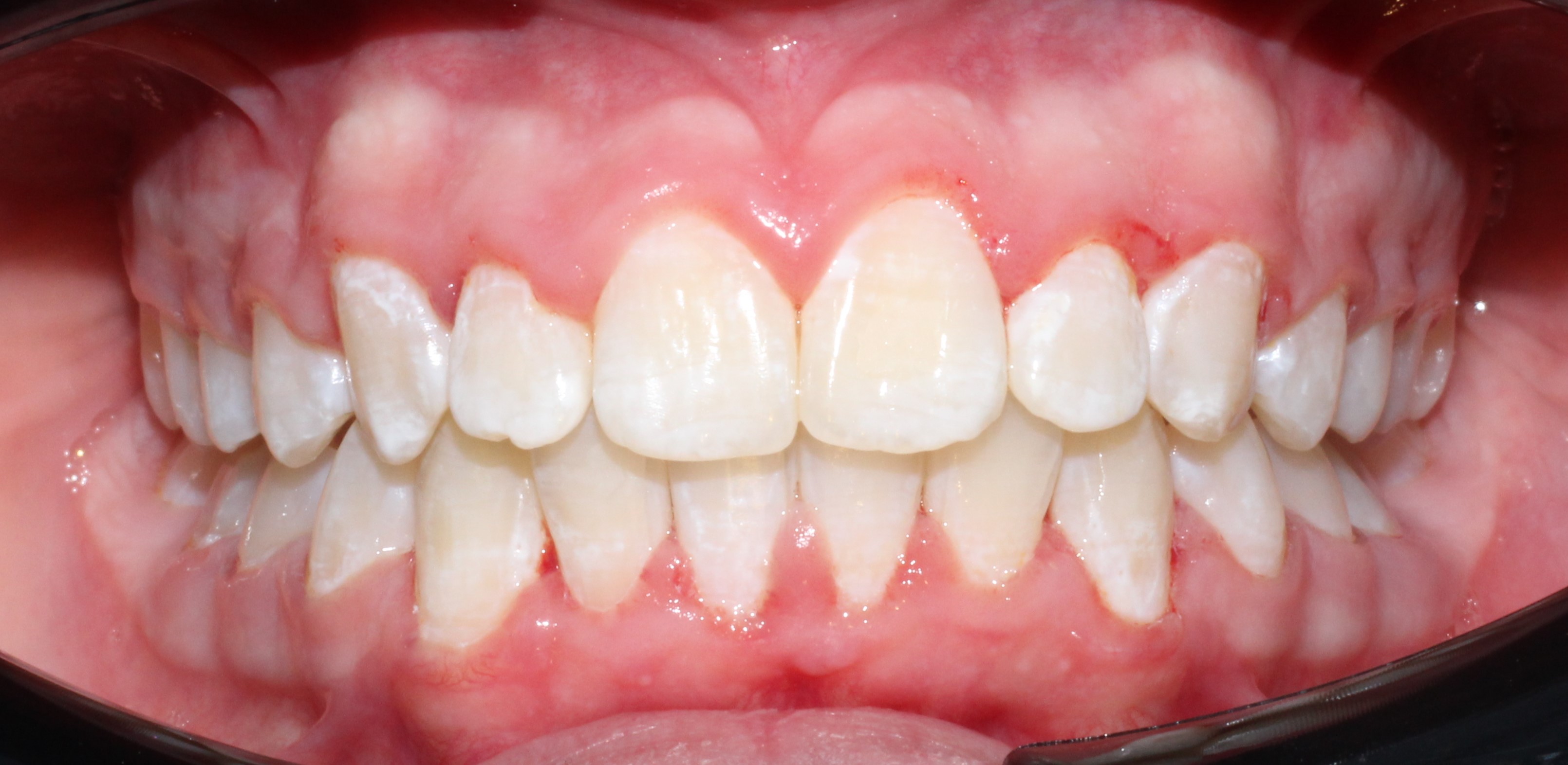 Глубокий прикус - после лечения