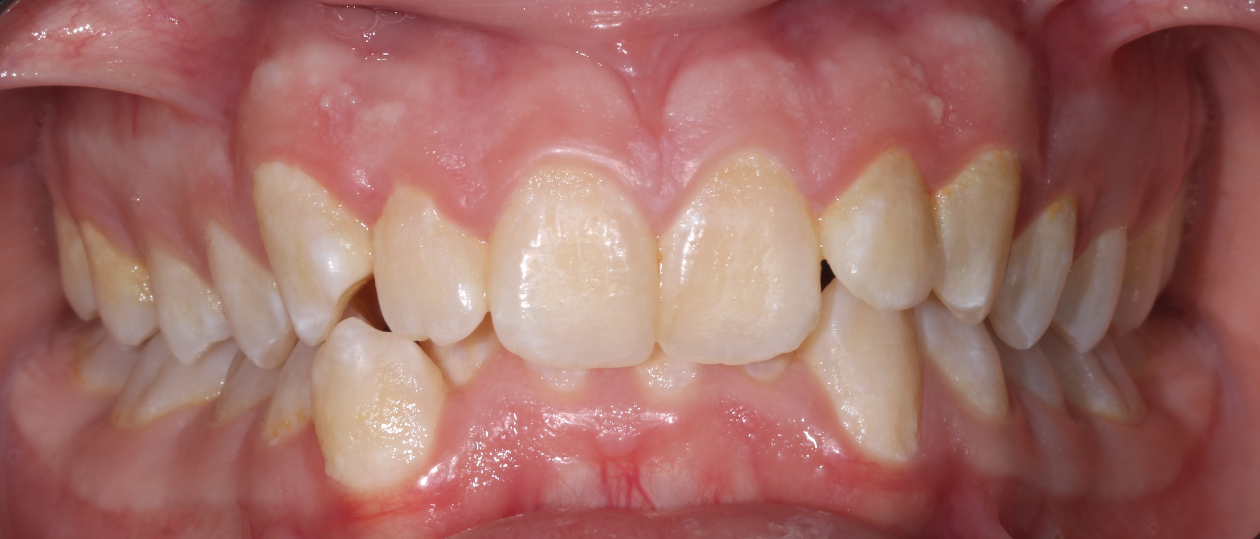 Глубокий прикус - до лечения