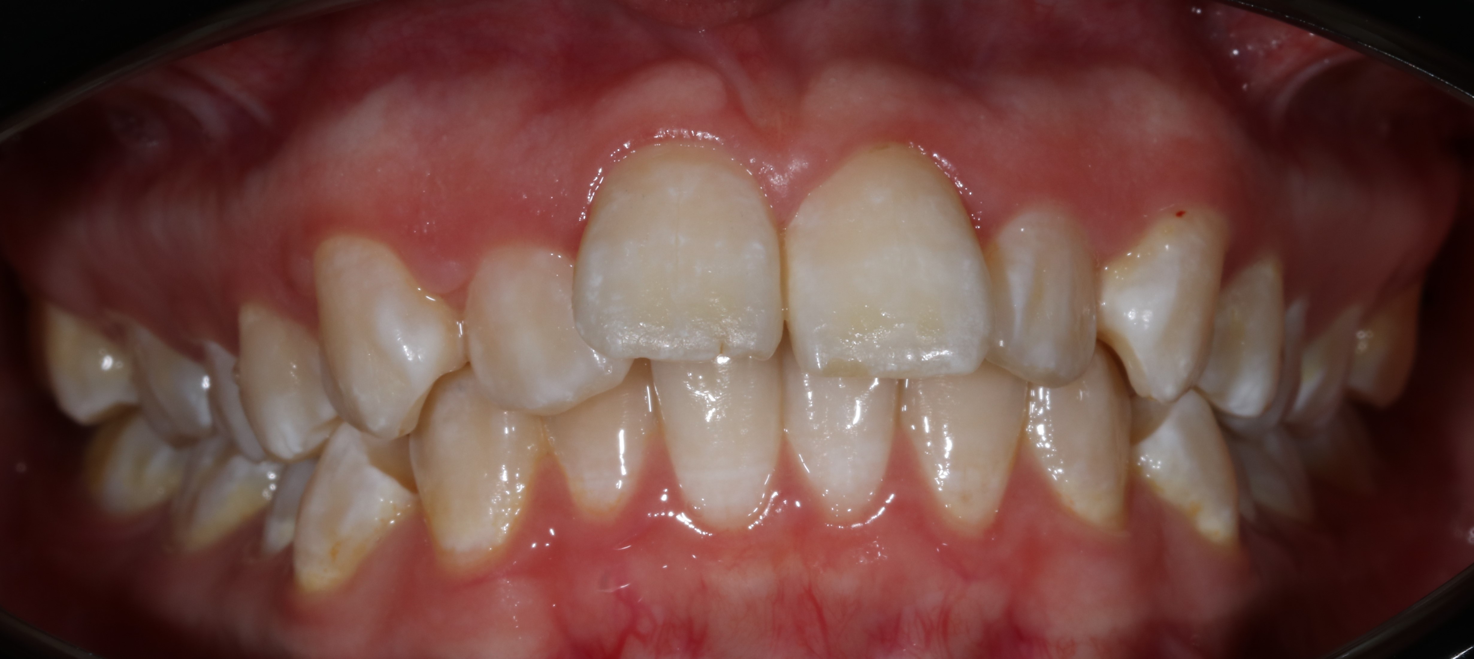 Скученность зубов - до лечения