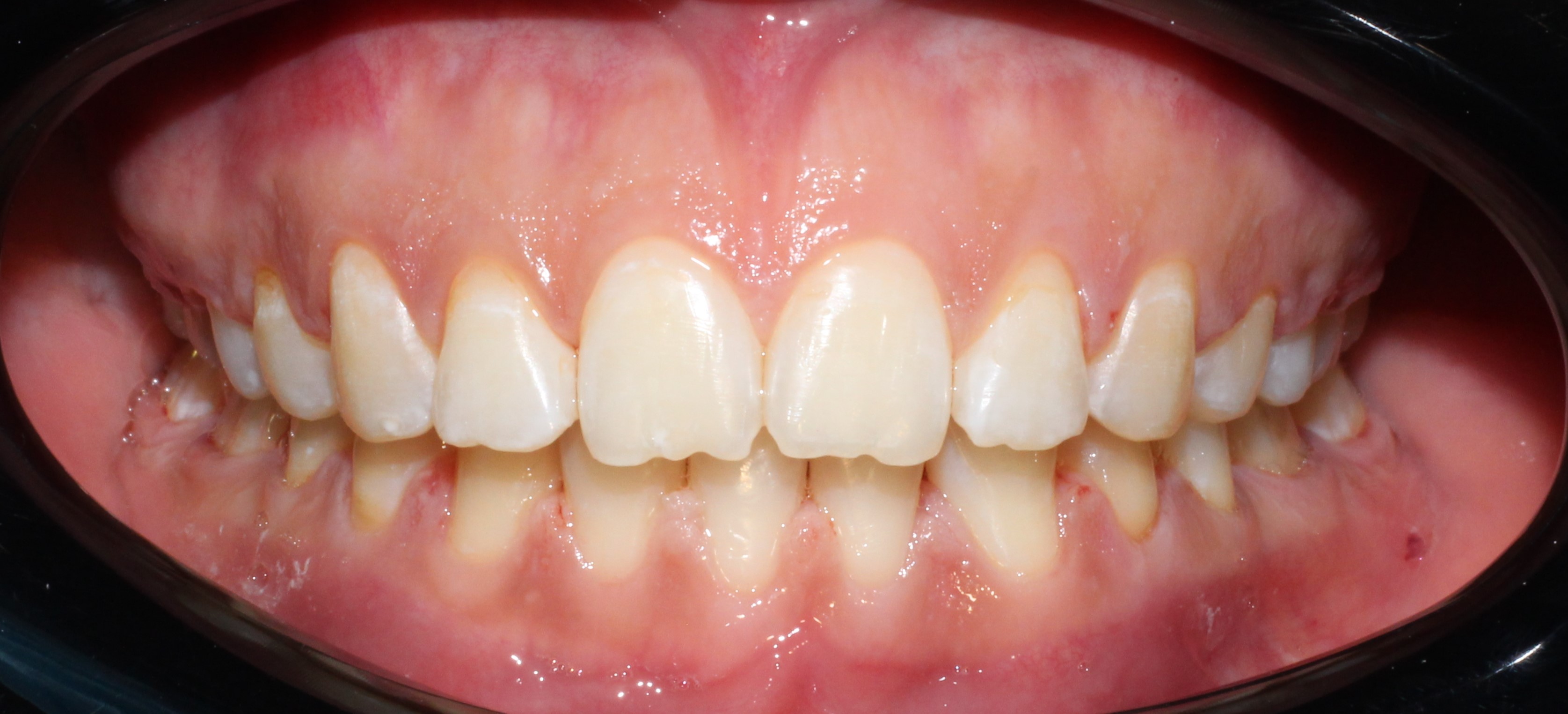 Открытый прикус, тремы - после лечения