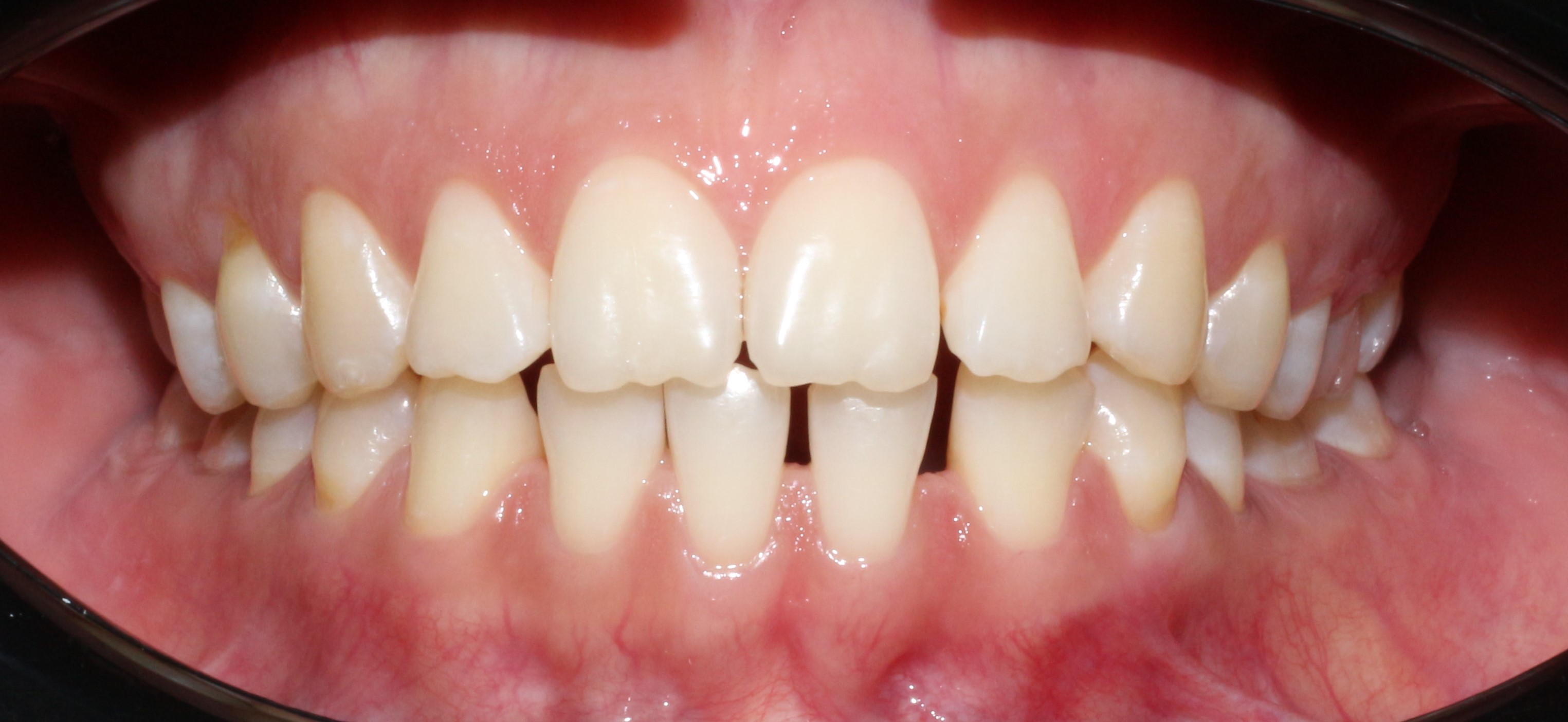 Открытый прикус, тремы - до лечения