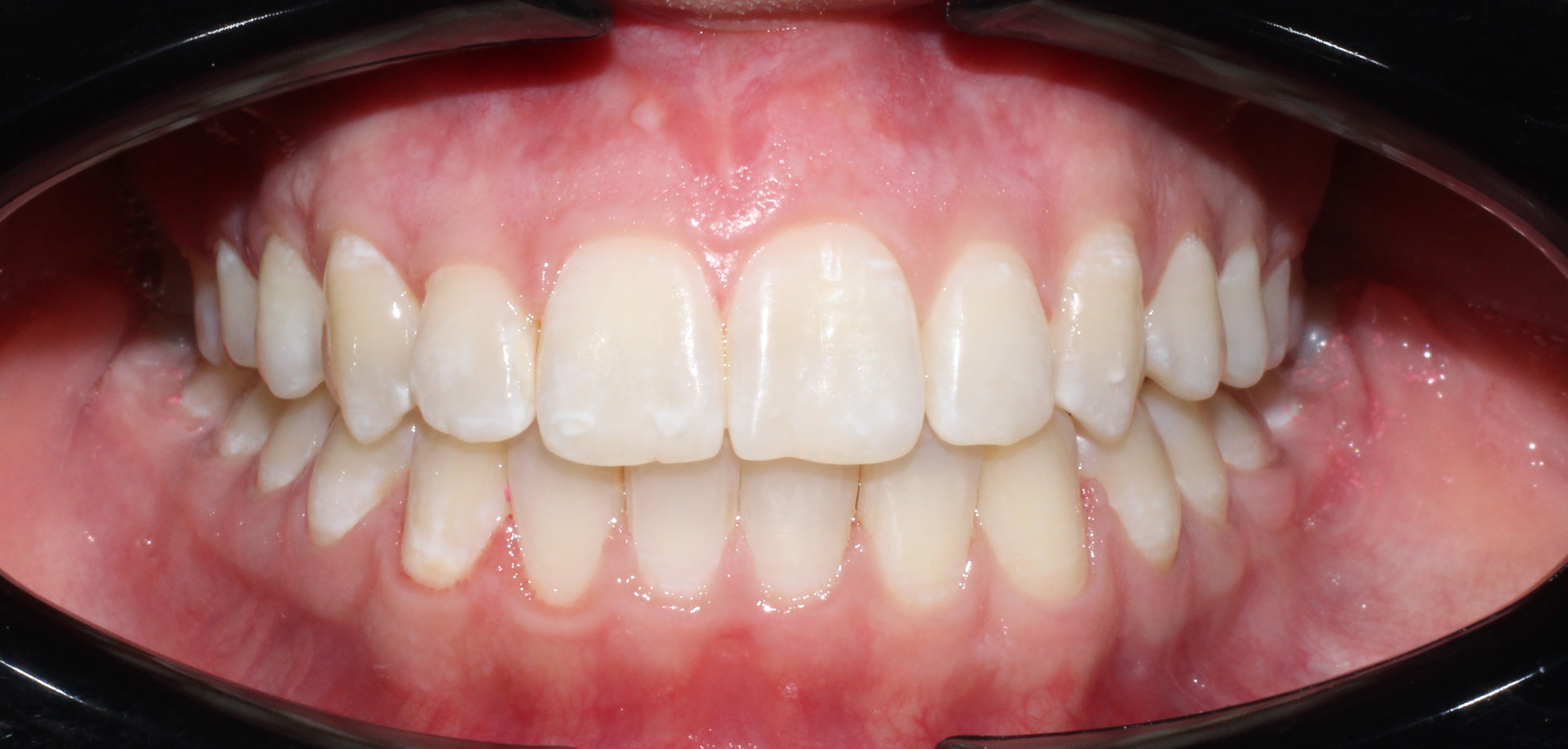 Смещение центральной линии - после лечения