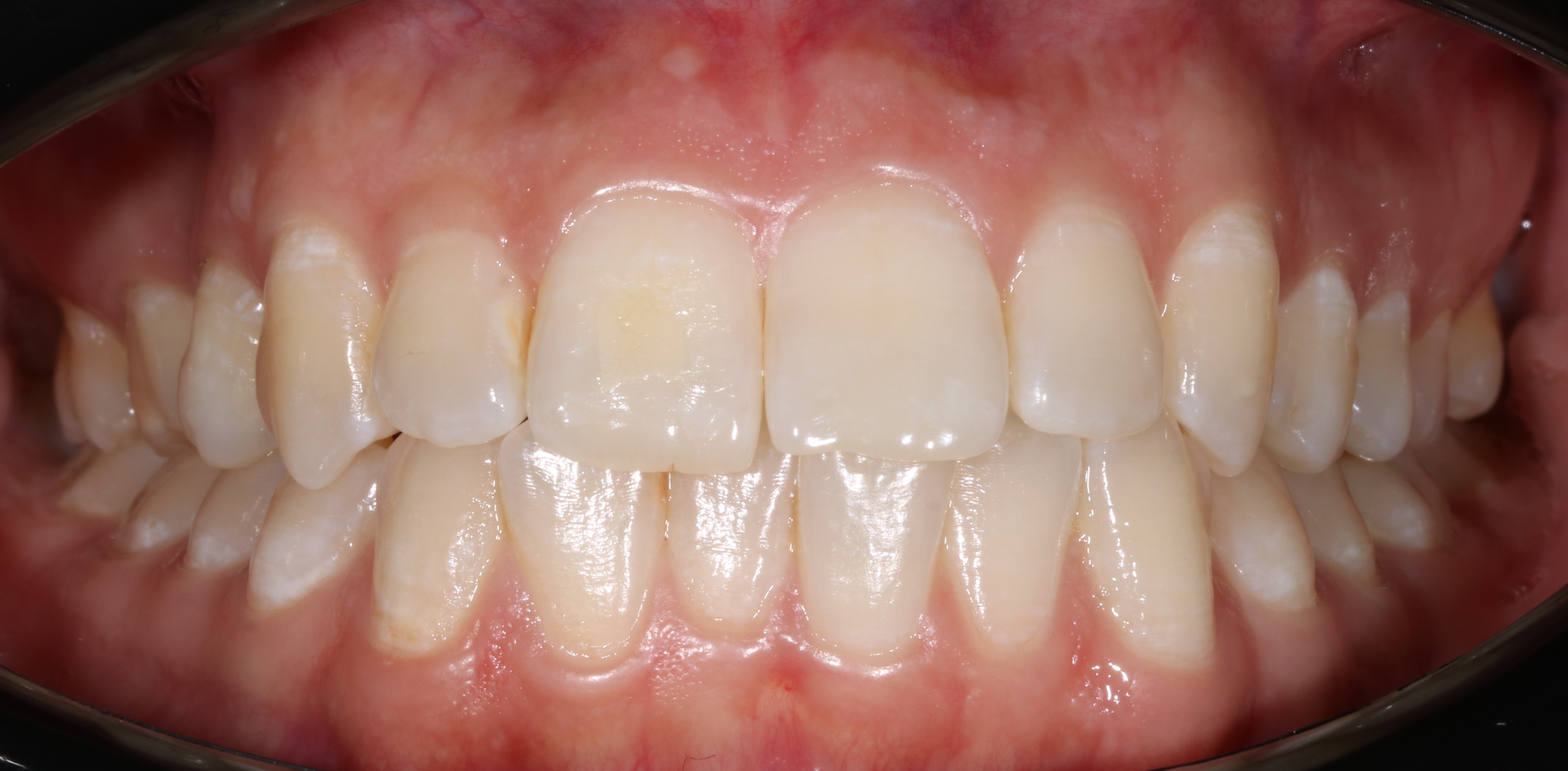 Смещение центральной линии - до лечения