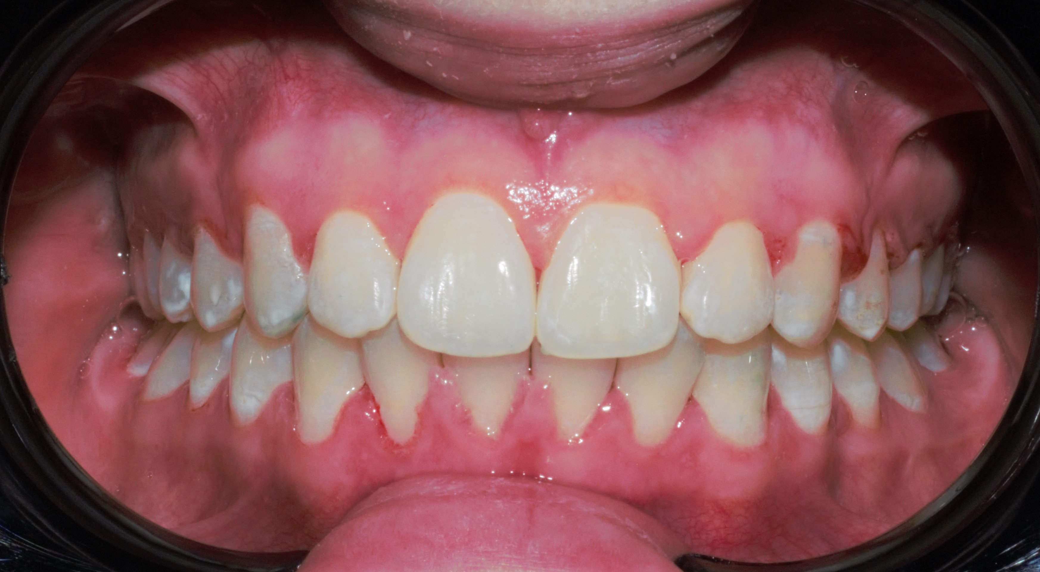 Ротация зубов - после лечения