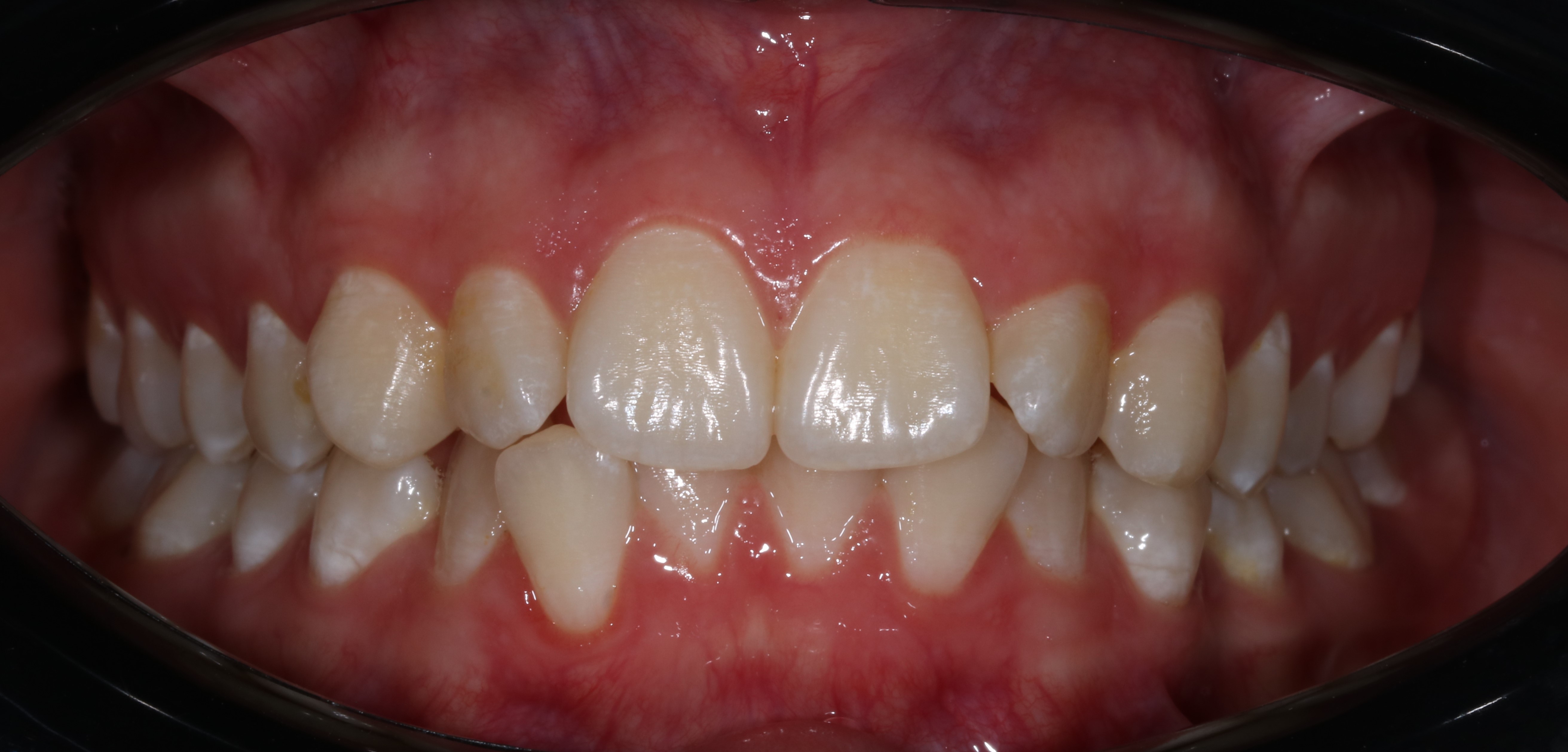 Ротация зубов - до лечения